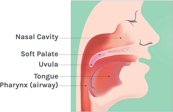 sleep apnea symptoms