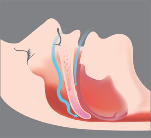 obstructive sleep apnea